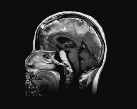 Mri With Contrast Showing The Parasellar Meningioma Download