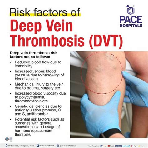 Deep Vein Thrombosis DVT Symptoms Causes And 41 OFF