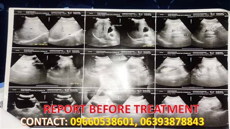 CASE REPORT OF PATIENT SUFFERED FROM 4 6 MM GALL BLADDER POLYP