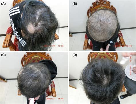 Clinical Course Of A Patient With Alopecia Areata A Her Hair Download Scientific Diagram