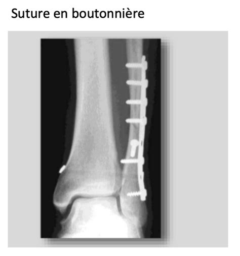 Mise Au Point Sur Le Complexe Ligamentaire De La Syndesmose Tibio