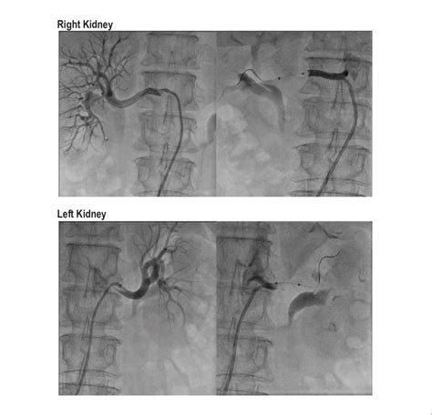 Renal Denervation Procedure Selective Angiography Performed With A 7 F Download Scientific