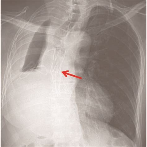 Chest computed tomography showing right pneumonectomy and oesophageal ...