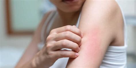 Identifying Mold-Related Skin Rashes: Symptoms and Signs – Moldfear.com