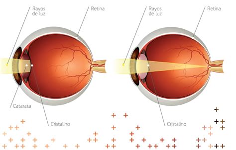 Qué son las Cataratas Visión 100 Oftalmólogos Monterrey México