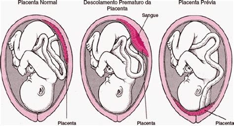 Blog Do Ramon Lamar A PLACENTA 18090 The Best Porn Website