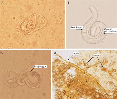 Strongyloides Stercoralis Embryonated Ova In The Lung — Nejm