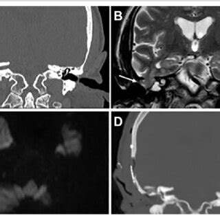 (PDF) Otogenic Pneumocephalus After Tegmen Bone Reconstruction: A Case Report