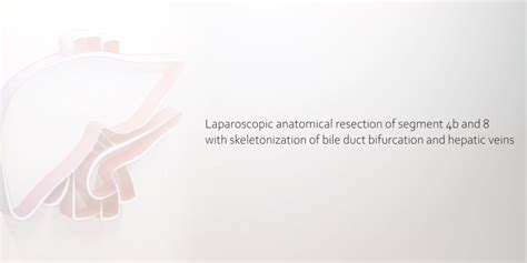 Laparoscopic Anatomical Resection Of Segment 4b And 8 Using The Caudal