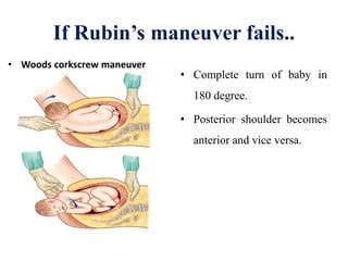 Rubin Maneuver