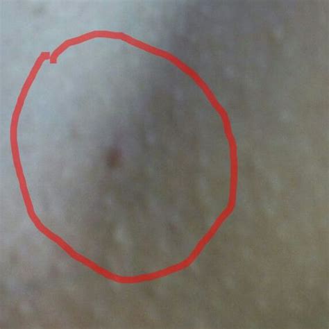 Granito Cerca De La Vagina Dermatologo Net