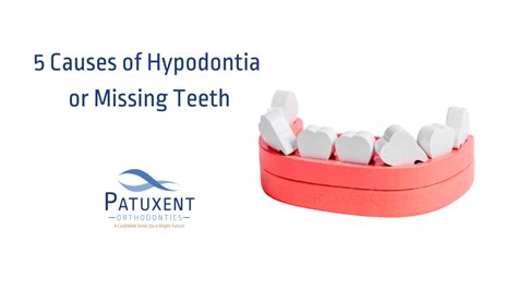 5 Causes of Hypodontia or Missing Teeth