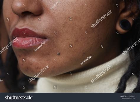 19,019 Black acne Images, Stock Photos & Vectors | Shutterstock