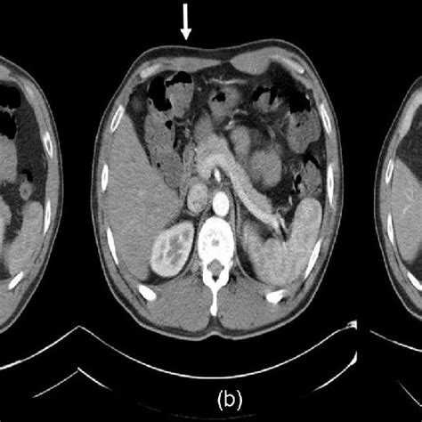 A Preoperative Abdominal Ct Scan Revealed Symmetry In The Thickness