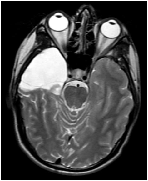 Papilledema Mri