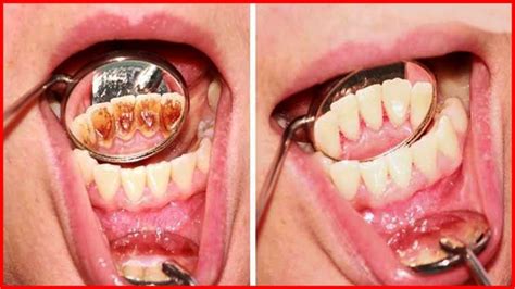 Cremes Caseiros Para Remover O T Rtaro Dos Dentes Receitas E Dicas