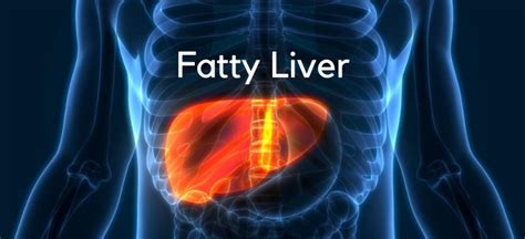 Fatty Liver Causes Symptoms And Diagnosis