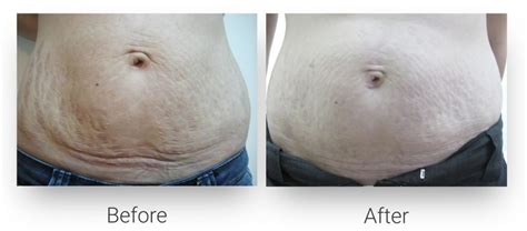 Stretch Mark Reduction Vida Lift Clinic Center