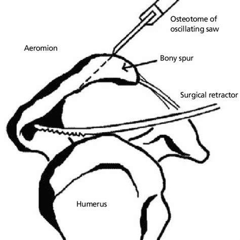 Arthroscopic acromioplasty. | Download Scientific Diagram