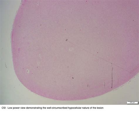 Pathology Outlines Collagenous Fibroma