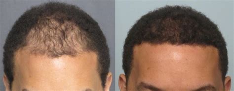 Men's African American Hair Transplant « %%Dr Sean Behnam%%