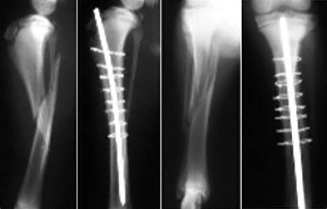 A Practitioners Guide To Fracture Management Part 3 Selection Of