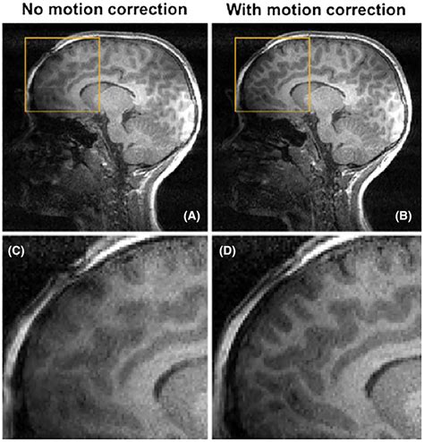 Robin Medical Inc Motion Artifact Correction