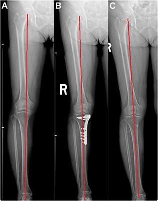 Frontiers Medial Opening Wedge High Tibial Osteotomy With