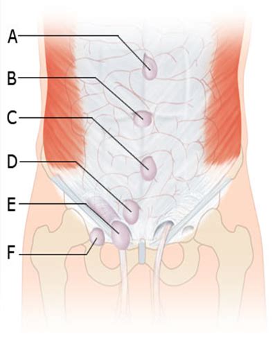 Hernias Surgery Flashcards Quizlet