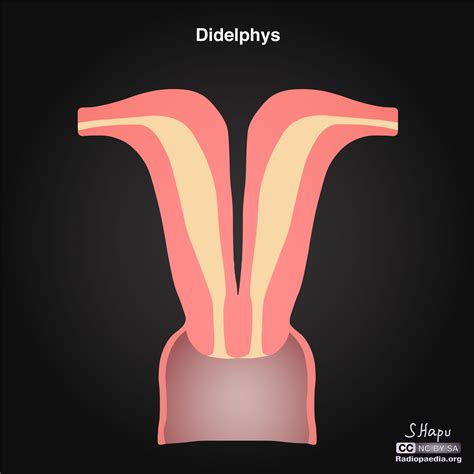 Uterine Anatomical Abnormalities Illustrations Image