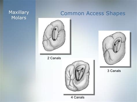 Coronal Cavity Preparation ‘access