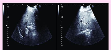 Sonography Of The Biliary System Demonstrating Undilated Intra And Download Scientific Diagram