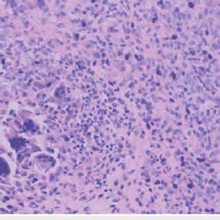 Histopathological Examination Showing Multi Nucleated Giant Cells With