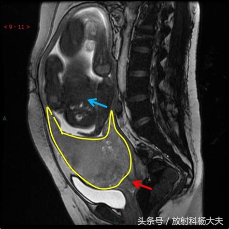 Mri上觀察到的前置胎盤是什麼樣子 每日頭條