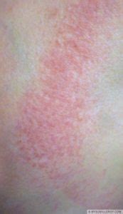 Polymorphous Light Eruption(PMLE) pictures and sun allergy rash images