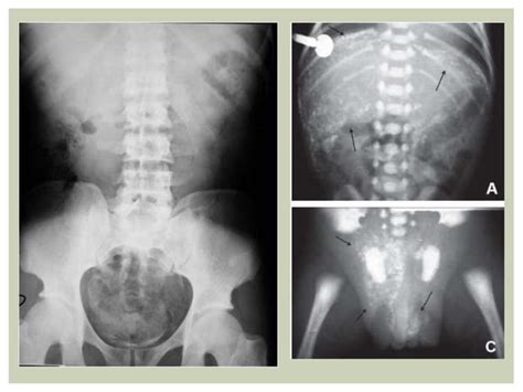 Calcificaciones Pptx