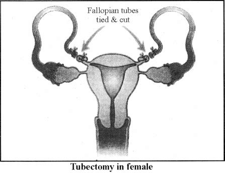 What is Tubectomy? - Sarthaks eConnect | Largest Online Education Community