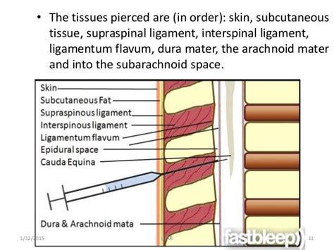 Lumbar Puncture