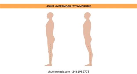 Joint Hypermobility Syndrome Hypermobility Spectrum Disorder Stock