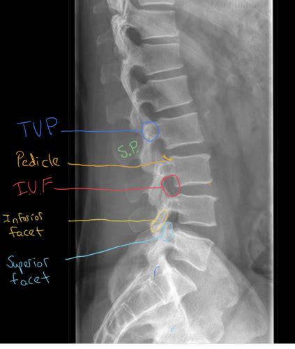 Lumbar Spine Flashcards Quizlet