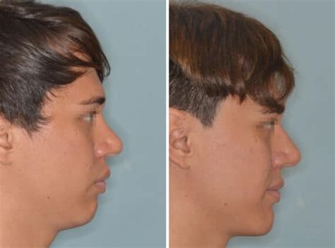 Revision Rhinoplasty Photos Dr Anthony Bared Md Facial Plastic