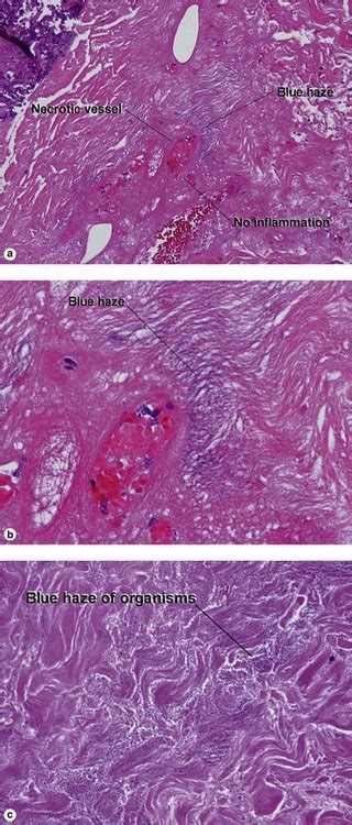 Bacterial Spirochete And Protozoan Infections Plastic Surgery Key