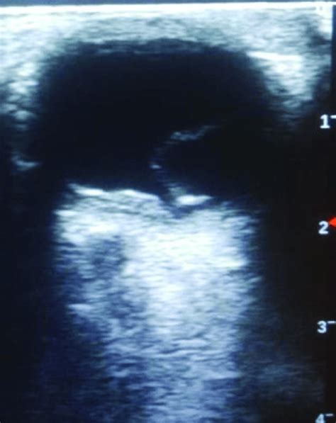 B Mode Ocular Ultrasound Of The Left Eye Showing Retinal Detachment