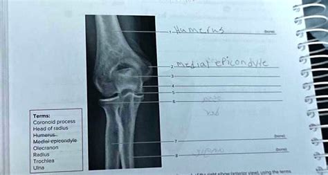 Solved Texts 93 Medial Epicondyle Terms Coronoid Process Head Of