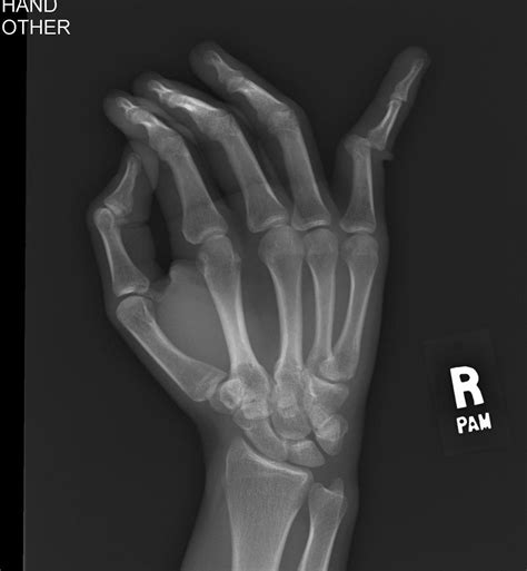 Dislocated my pinky playing basketball : r/XRayPorn