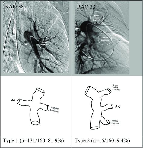 Most common anatomic variations in the origins of the superior ...