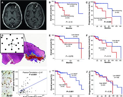 Markers Of Disease Progression In Oligodendroglioma A T Weighted Axial