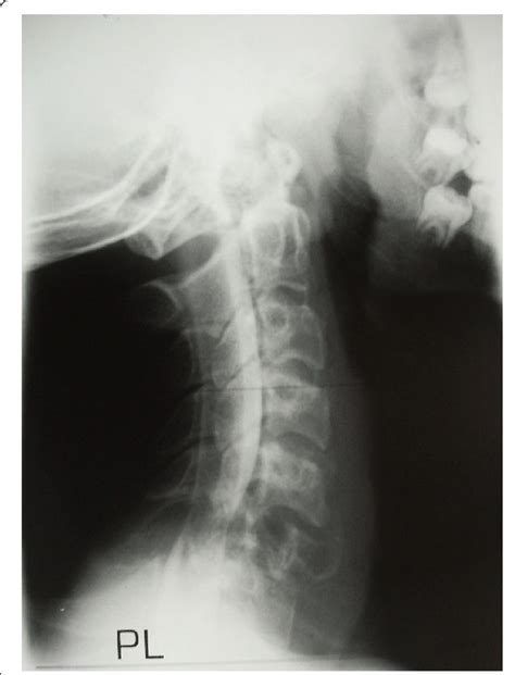 Lateral Radiograph Of The Cervical Spine Of The Young Athlete Showing