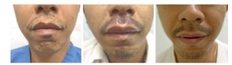 Moustache Transplant Benefits Costs Risks And Results