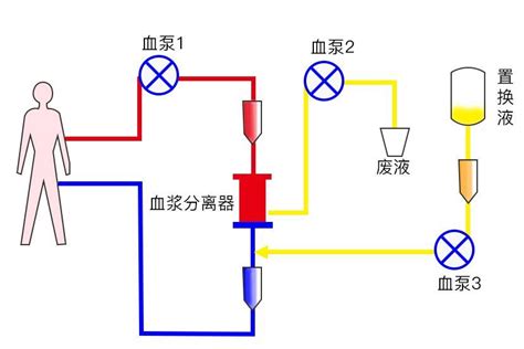 血浆置换图片妙手医生